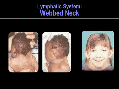 turner syndrome webbed neck