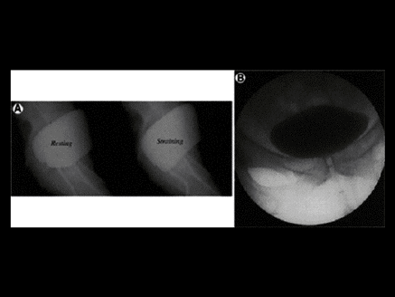 Stress Urinary Incontinence: Expanding the Treatment Options