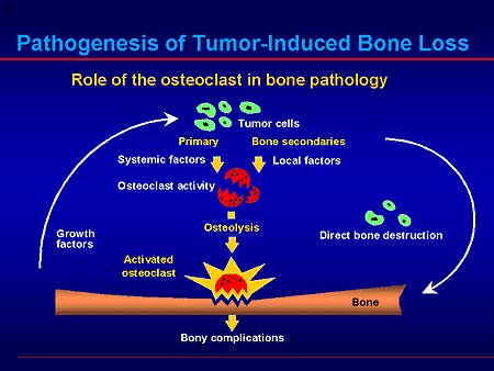 The Evolving Role of Bisphosphonates for Cancer Treatment-Induced Bone Loss