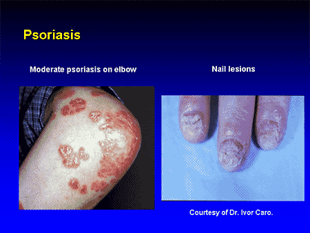 New Horizons in TNF Inhibition - Topic 1: Treating Ankylosing Spondylitis