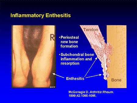 Enthesis inflammation image