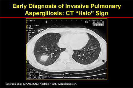 Update on Fungal Disease 2003