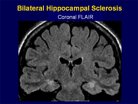hippocampus anatomy mri hippocampus anatomy mri