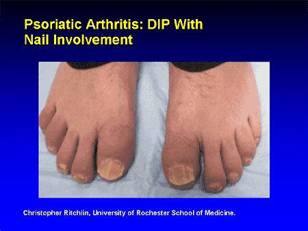 New Horizons in TNF Inhibition - Topic 2: Targeting Psoriatic Arthritis