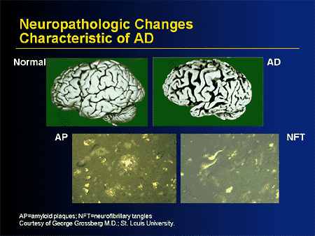 The Treatment of Alzheimer's Disease and Disease Progression Modification