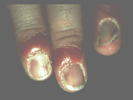 Fungal Nail Infections: Treating From Head To Toe