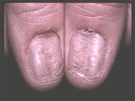 Fungal Nail Infections: Treating From Head To Toe