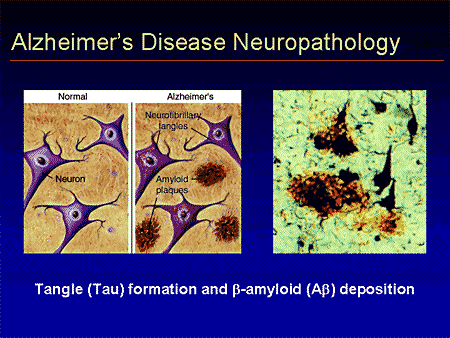 Current Alzheimer's Disease Treatments And Beyond: Advances Impacting ...