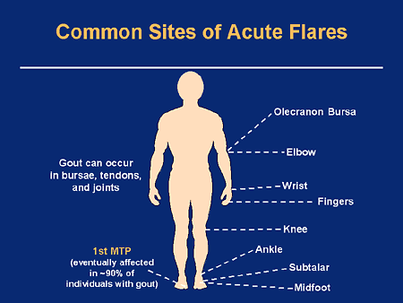 Hyperuricemia And Gout