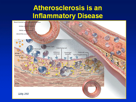 The Pulse of Current Cardiovascular Concern: Anti-inflammatory Medications