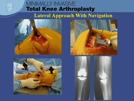 Lateral Approach With Navigation