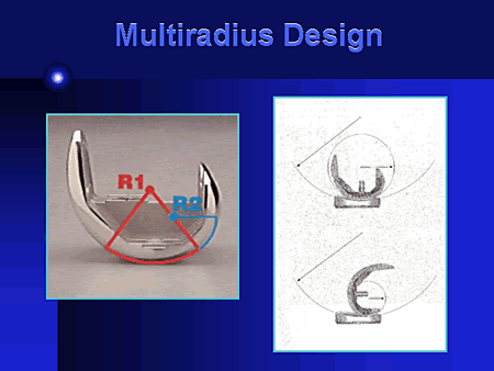 Multiradius Design