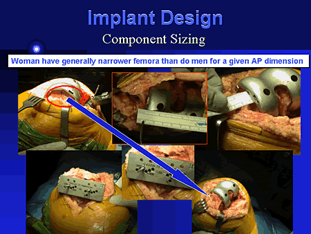 Implant Design: Component Sizing