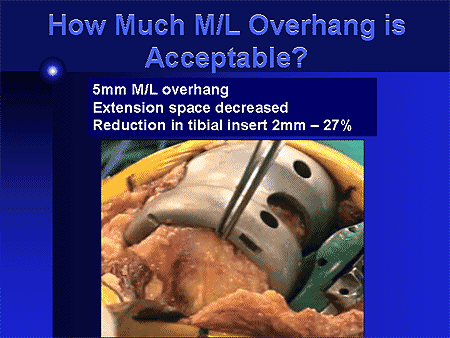 How Much M/L Overhang Is Acceptable?