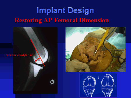 Implant Design: Restoring AP Femoral Dimension