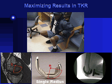 Maximizing Results in TKR