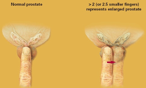 Finger prostata The Male