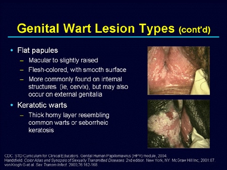 do genital warts always cause cervical cancer