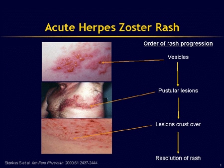 Herpes zoster фото