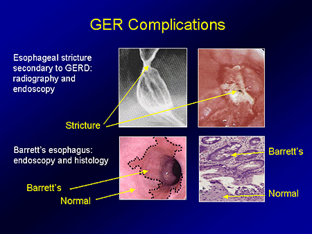 Pediatric GERD: A Problem-Based Approach to Understanding ...