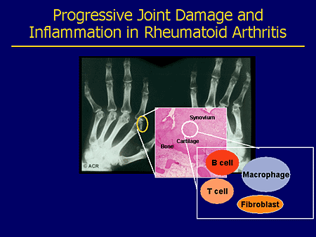 B-Cell Targeted Therapies: The Future Of RA Targeted Management