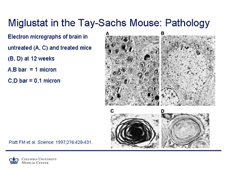 Pathology of Tay Sachs Disease