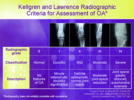 Integrating Viscosupplementation Into A Comprehensive Osteoarthritis Treatm