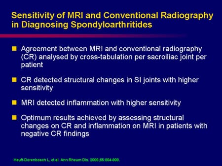 Sensitivity Radiography Refining the Focus: A New Look at Spondylitis