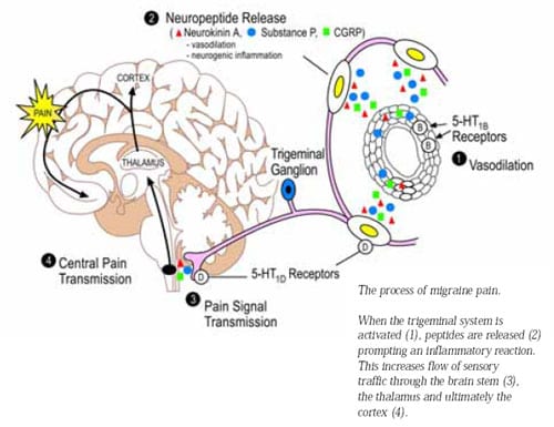 Understanding Migraine