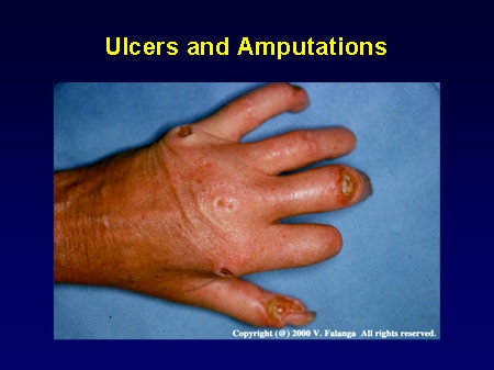 Vascular Complications of Systemic Sclerosis