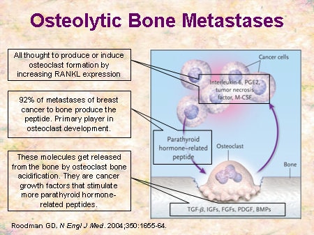 bone disease metastatic osteolytic metastases bisphosphonates slide emerging opportunities