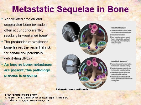 bone slide metastatic bisphosphonates emerging opportunities disease sequelae