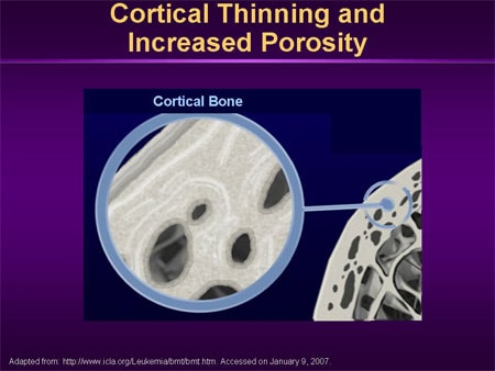 Current Concepts In Osteoporosis