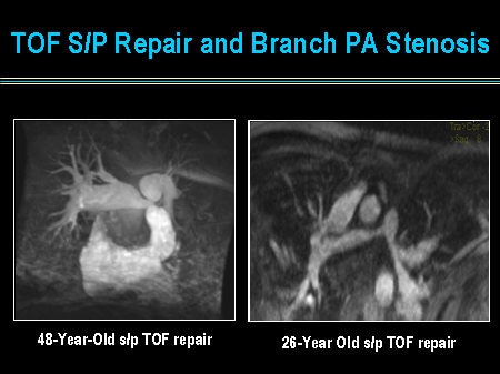 Slide 24. TOF S/P Repair and Branch PA Stenosis