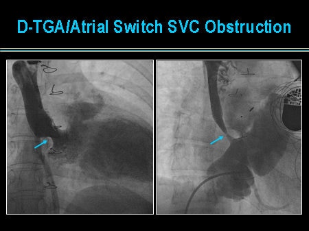 Slide 25. D-TGA/Atrial Switch SVC Obstruction