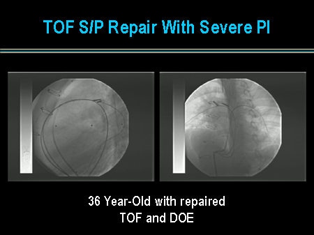 Slide 27. TOF S/P Repair With Severe PI