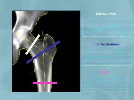 Qualities of Bone and the Effects of Treatment (Slides with Transcript)