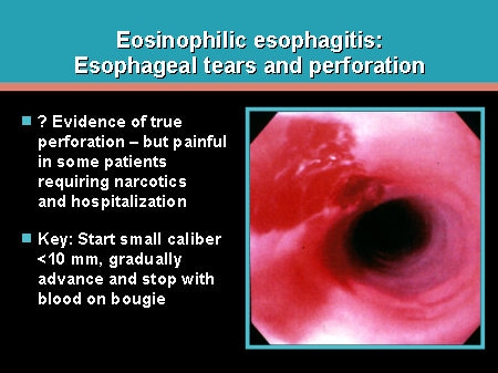 Eosinophilic Esophagitis: More Than Child's Play! (Slides with Transcript)