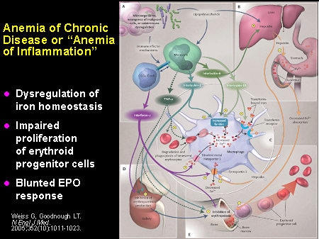 Anemia of Chronic Disease or "Anemia of Inflammation"
