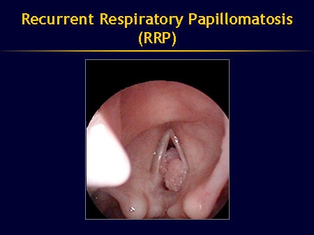 respiratory papillomatosis neonate)