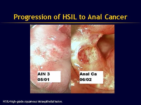 HPV-Related Disease in Men: Anal and Penile Cancer (Slides With Transcript)