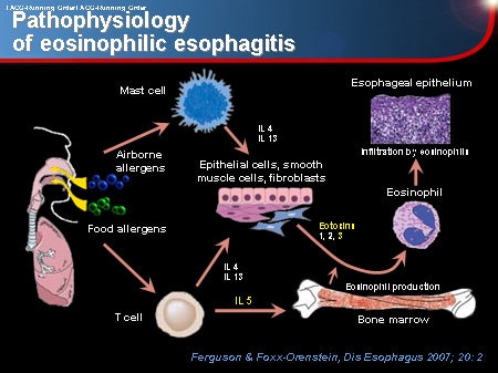 Mechanisms Of Eosinophilic Esophagitis Conventional