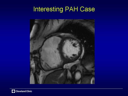 Emerging Role of Advanced Imaging in PAH (Slides With Transcript)