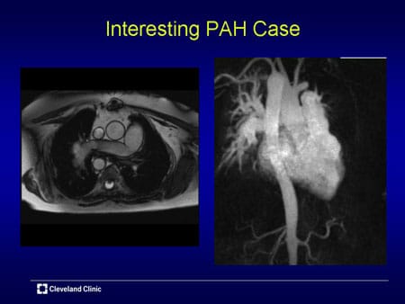 Emerging Role of Advanced Imaging in PAH (Slides With Transcript)