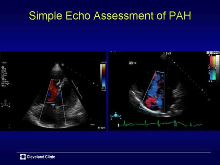 Emerging Role of Advanced Imaging in PAH (Slides With Transcript)