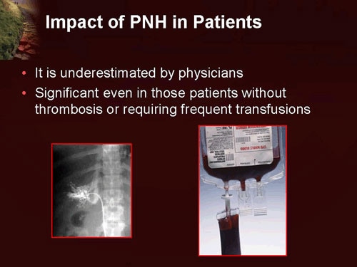 paroxysmal nocturnal hemoglobinuria definition