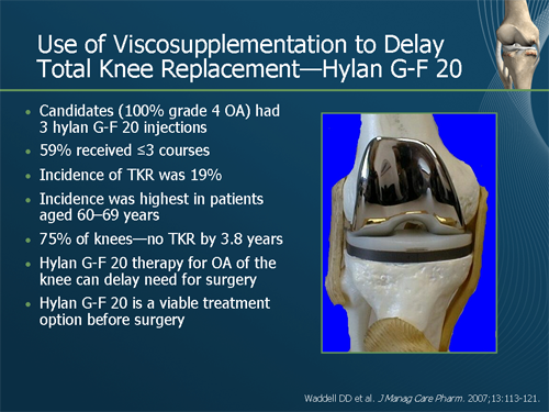 Viscosupplementation For Knee OA: Improving Outcomes (Slides/Transcript)