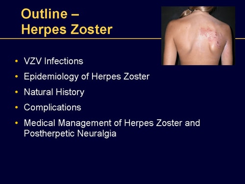 clinical presentation of herpes zoster