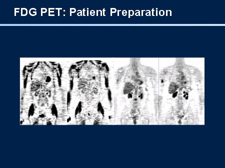 NCCN Task Force Report: PET/CT Imaging (Slides With Transcript)