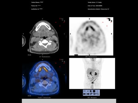 NCCN Task Force Report: PET/CT Imaging (Slides With Transcript)